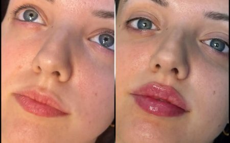 Best Aesthetic Clinic in dubai for Fillers: How to Achieve Youthful, Natural Results