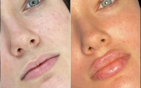 The Best Doctors in Dubai Share Insights on Patient Selection for Russian Lip Fillers