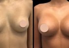 Best Breast Enlargement Surgeon in Dubai: The Role of Technology in Achieving Perfect Results