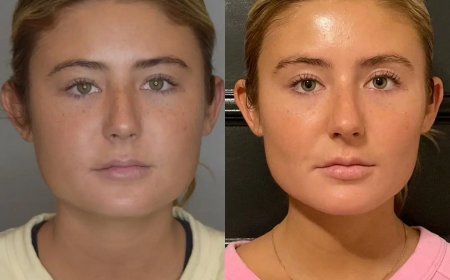 Why Buccal Fat Removal is the Latest Trend and How to Find the Best Doctors in Dubai