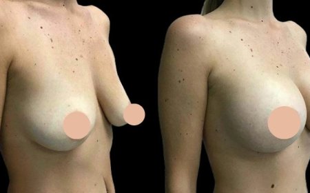 Why Choosing the Best Doctors in Dubai Matters for Breast Augmentation Success